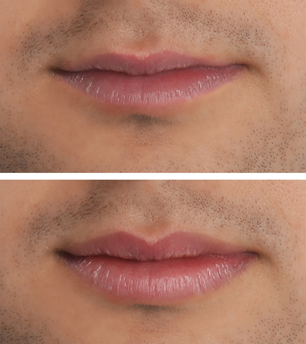 Lippen aufspritzen mit Hyaluron im Saarland für sinnliche und volle Lippen - das Bild zeigt einen Vorher-Nachher-Vergleich